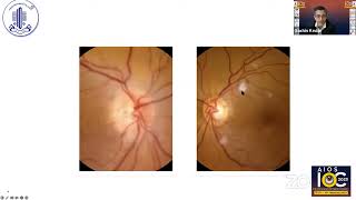 Ischemic optic neuropathy - Dr. Sachin Kedar