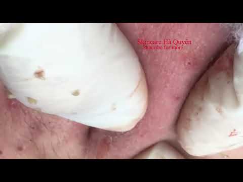 Acne and Blackheads Removal Mouth and Chin