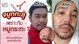 คนเคยศัลย์ แชร์ประสบการณ์เสริมจมูก จมูกทะลุ เพราะหมูกระทะ