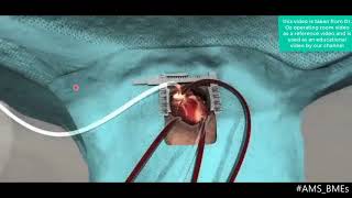 شرح جهاز القلب والرئة الصناعية بالعربي ( ال Heart Lung Machine )