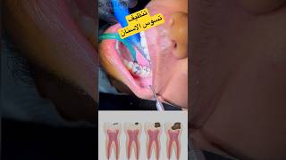 إزالة تسوس الاسنان | Dental Caries Removal