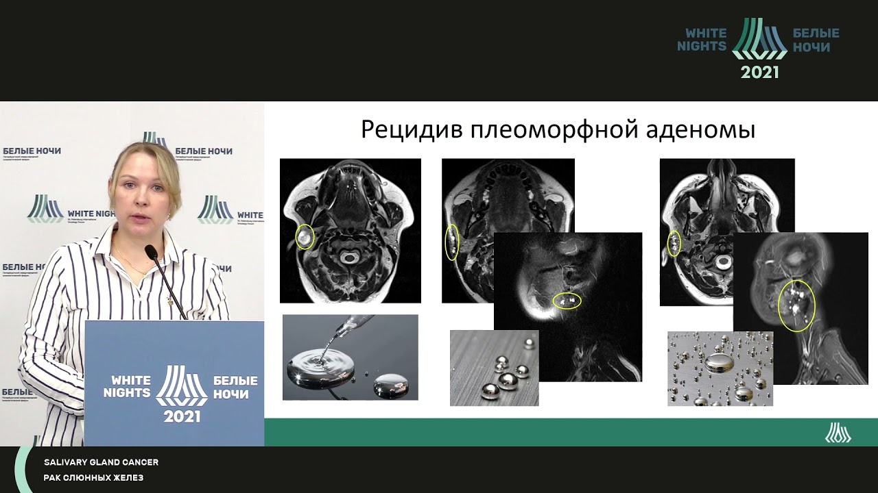 МР-картина малых и больших слюнных желез (Пономарева О.И.)