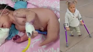 Mom Found Out Her Baby Has Mermaid Legs  Wont Live Long   She Takes First Steps 5 Years Later