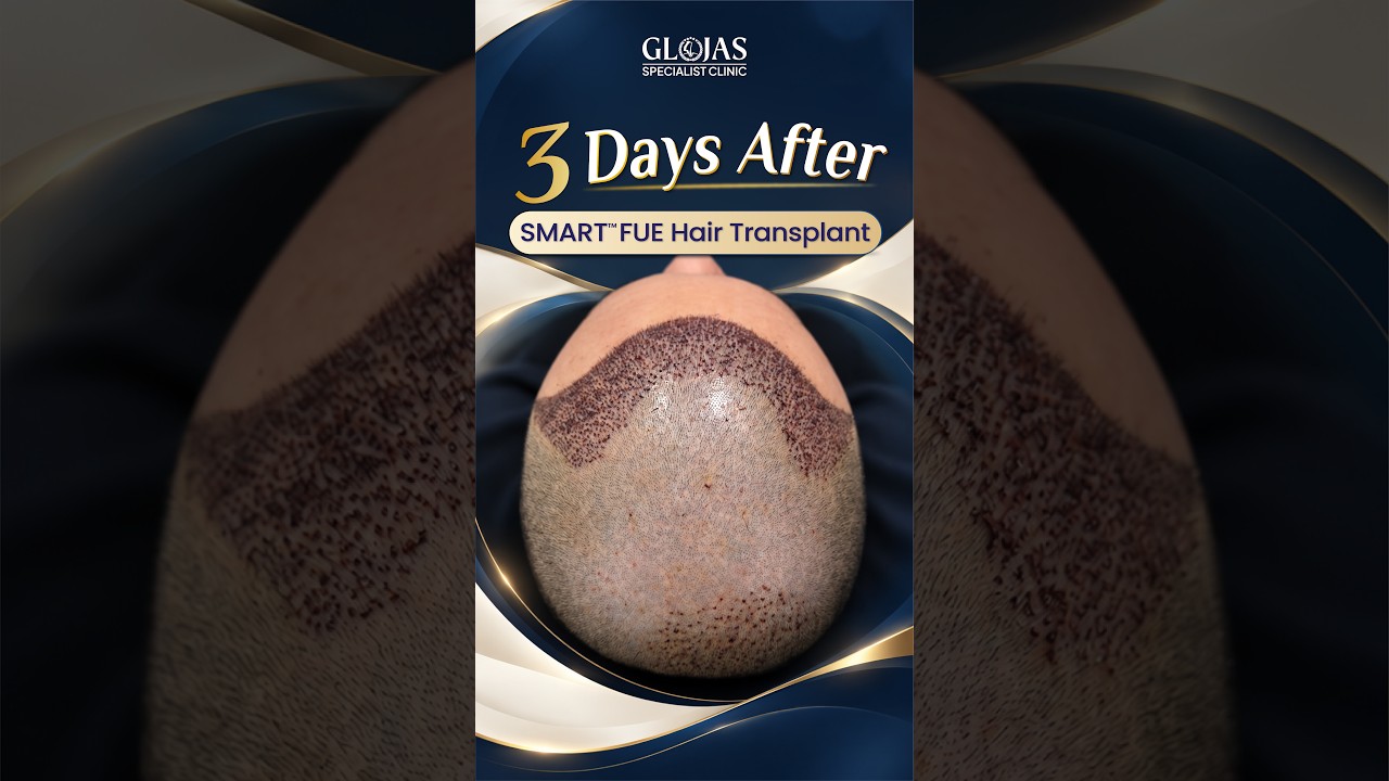 Our Doctors 8 Hair Transplant Malaysia l Day 3 after SMART™ FUE transplant! 🌱 #hairtransplantmalaysia