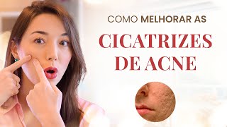 VEJA OS PRINCIPAIS TRATAMENTOS PARA AMENIZAR AS CICATRIZES DE ACNE