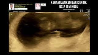Kembar identik 11-12 minggu