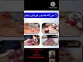 cupping Therapy-hijama बिमारियों का ईलाज بیماریوں کا حل #shortsviral #healthy Bharatklog