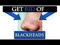 How to get rid of BLACKHEADS on your nose | 7 TIPS FOR MEN
