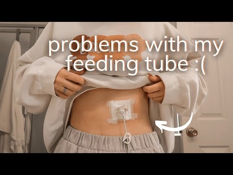 Ssbbw Tube Feeding