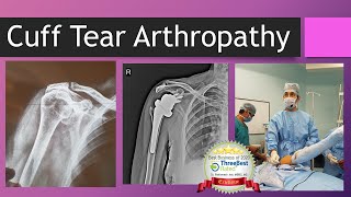 Shoulder Rotator Cuff Tear Arthropathy English