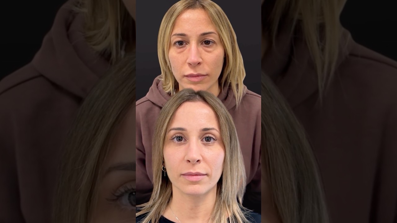 Un caso di trasformazione totale del viso che preserva l'autenticità dello sguardo. In questo video, mostriamo i risultati a due mesi da un intervento combinato di blefaroplastica superiore e inferiore su una paziente di 36 anni. Abbiamo trattato le borse sotto gli occhi (presenti fin dall'infanzia), l'eccesso di pelle sulla palpebra superiore e ripristinato i volumi del viso (tempie e mid-face/Punto G) attraverso un delicato lipofilling con grasso autologo.
Il risultato? Un viso fresco, una transizione palpebra-guancia perfetta e la libertà di tornare a truccarsi (eyeliner compreso!) senza segni visibili.

Scopri di più sulla blefaroplastica superiore: https://oculoplasticabernardini.it/blefaroplastica-superiore/
Scopri di più sulla blefaroplastica inferiore: https://oculoplasticabernardini.it/blefaroplastica-inferiore/
Prenota una visita: https://oculoplasticabernardini.it/dove-sono/

https://oculoplasticabernardini.it/blefaroplastica-superiore/

📞 Prenotazioni / Appointments
Genova/Genoa: +39 010 807 8121
Milano/Milan: +39 375 581 7488 · Info trattamenti/Treatment info: +39 351 717 0211
👉 Prenota / Book: oculoplasticabernardini.it/prenota