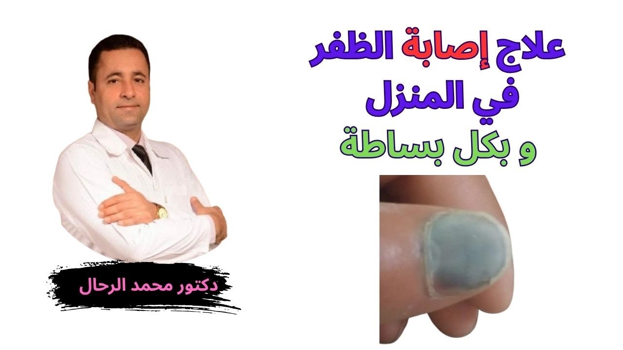 تجمع الدم تحت الظفر..علاج منزلي بخطوة واحدة