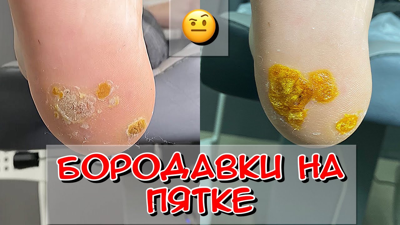 Бородавки на пятке / бородавка / мозоли / Педикюр - YouTube