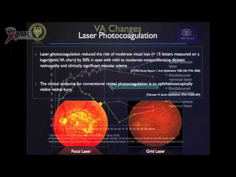 Professor Francesco Bandello - Diabetic Macular Edema - Part 1