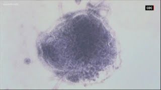 Health officials confirm fourth measles case in Maryland, warn of possible exposures