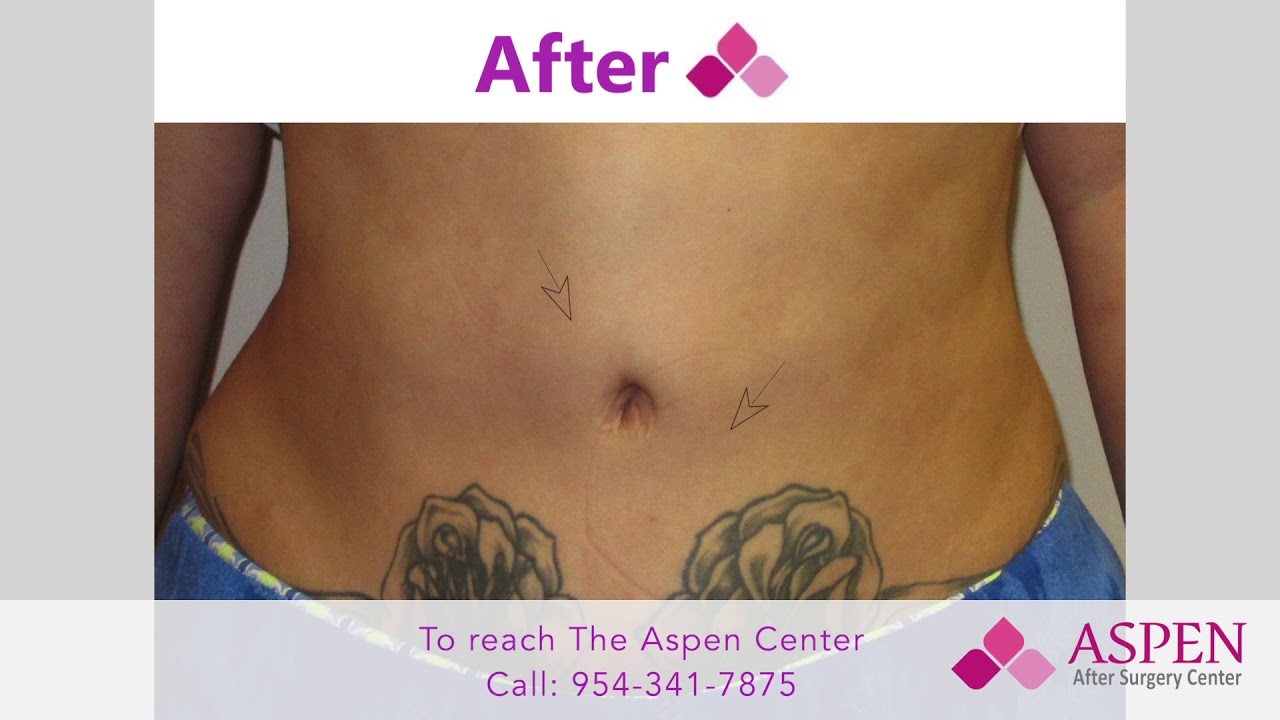 How to Prevent and Correct Uneven Areas in Your Belly After Liposuction