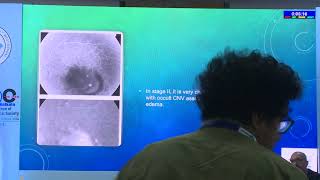 AIOC2024  GP91 Topic  Dr  S Natarajan FFA & ICG in AMD