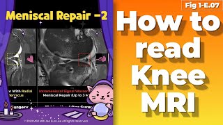 (Fig 1-E.07) Expected appearance of meniscal repair -2