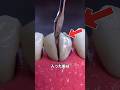 腐った歯を抜いて骨にネジを打つ手術