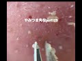 【acne pimple】 やみつき角栓Part129