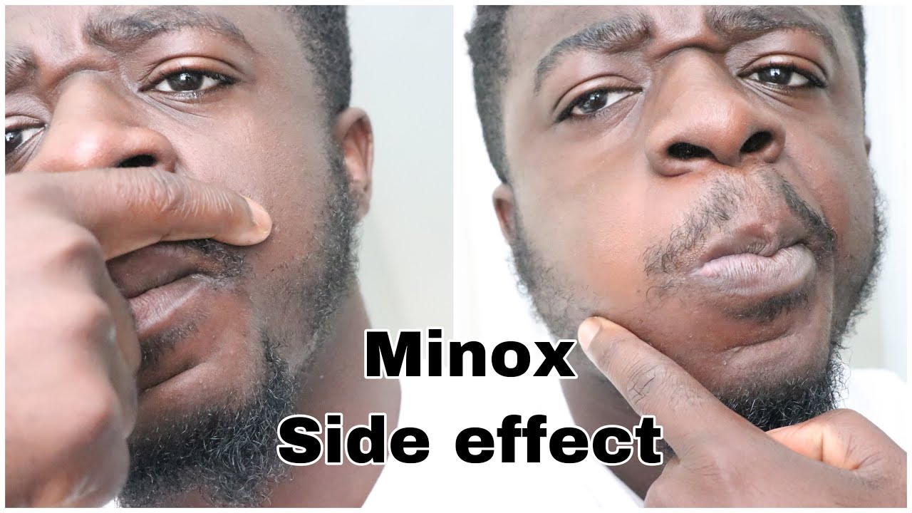 Assassin Forklaring Glorious A COMMON SIDE EFFECT MINOX/ROGAINE, AND MINOXIDIL USERS DON'T TELL YOU!!! -  YouTube