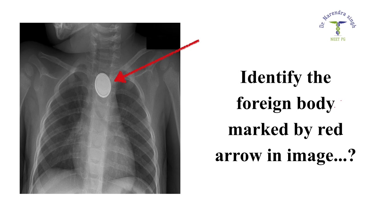 BUTTON BATTERY/NEETPG2021/ DNBCET/ INICET/ INEXT /FMGE/ MEDICAL/ENTIBQ