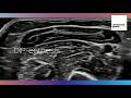 How to scan the DIP Enthesis? | MSK Ultrasound Tutorial