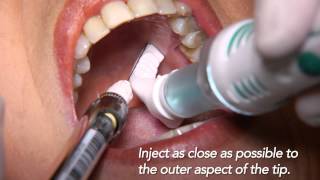 DentalVibe Clinical Applications