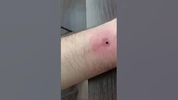 Как избавиться от укуса клеща. Полезный лайфхак.