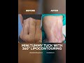 Before And After Of Mini Tummy Tuck With 360 Degree Lipocontouring Shorts 