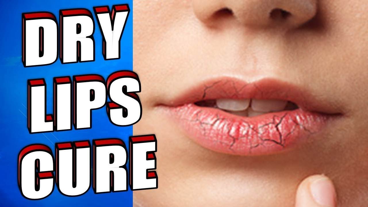 Fordyce Spots On Lips Treatment Apple Cider Vinegar And Honey