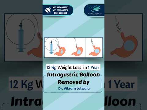 Intragastric Balloon Procedure by Dr. Vikram Lotwala | 12 Kg Weight Loss in 1 Year