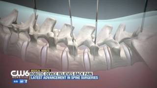 Mazor Renaissance Robotic Surgical Guidance System - Dr. Payam Moazzaz (Tri-City Medical Center)