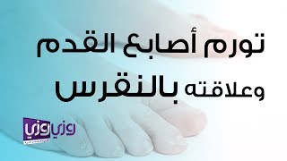 تورم أصابع القدم وعلاقته بالنقرس