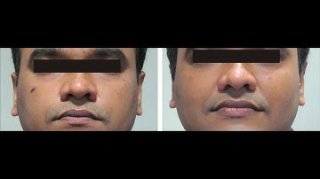 Chemical cauterization CPT code - simplify medical coding