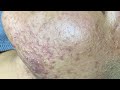 Acne Treatment For "Hung" (P5) | Điều Trị Mụn Cho Hùng (P5) =  SacDepSpa#192