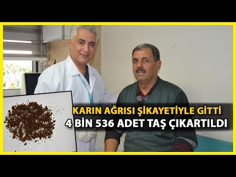 Safra Kesesinden 4 Bin 536 Taş Çıktı