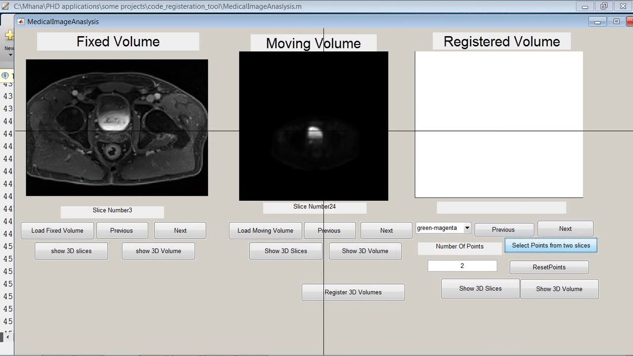 MRI-PET Medical Image 3D Registration