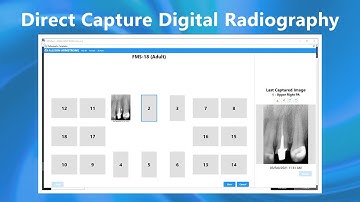 ABELDent: Direct Capture Digital Radiography