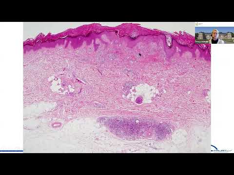 Eosinophilic Skin Diseases