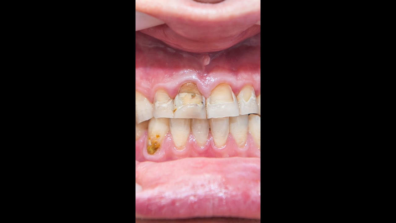 Understanding Dental Fillings What to Expect and How to Care for Them? YouTube
