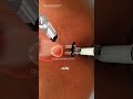 Trans perineal prostate biopsy procedure (3D animation) #drone #slipdiscsurgery #minimalinvasive