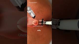 Trans perineal prostate biopsy procedure (3D animation) #drone #slipdiscsurgery #minimalinvasive