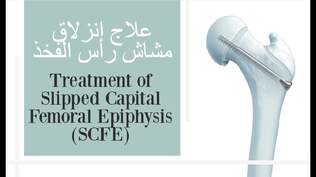 Лечение соскальзывания головного эпифиза бедренной кости (SCFE) (с субтитрами)