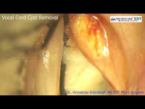 Vocal Cord Cyst Removal Dr. Vinnakota Sriprakash MS ENT Micro Surgeon