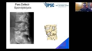 Inside the Spine: MRI Reading & Radiological Evaluation with Dr (Maj) Pankaj N Surange screenshot 1