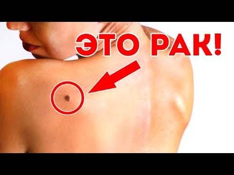 ЭТО РАК КОЖИ? онкология, внимание, меланома melanoma, профилактика!