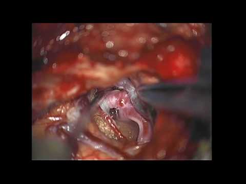 Brain Aneurysm Surgery