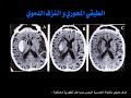 النزوف الدماغية والأشعة