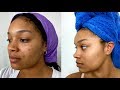CHEMICAL PEEL AT HOME! BEFORE & AFTER (EBANEL SKINCARE)